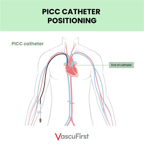 Peripherally Inserted Central Catheters Piccs The Key Principles