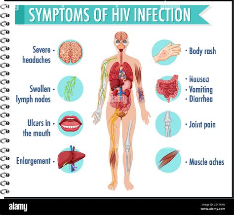 Symptome Einer Hiv Infektion Infografik Illustration Stock Vektorgrafik