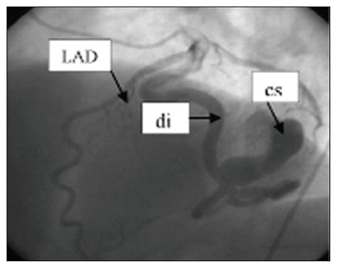 Left anterior descending artery d1: A case of angina pectoris with concomitant fistulization ...