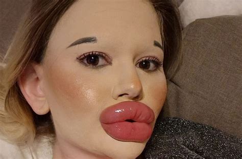 una mujer búlgara de 25 años se somete a más de 27 procedimientos para tener los labios más