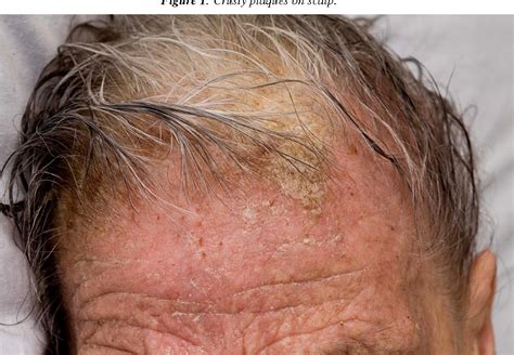 Figure 2 From Crusted Norwegian Scabies Treated With Oral Ivermectin