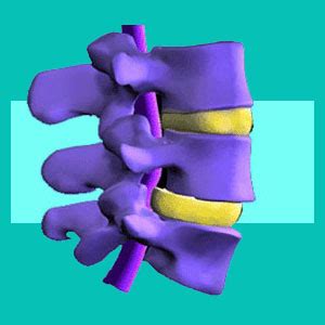 Check spelling or type a new query. Slipped Disc - Herniated Disc