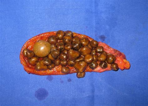 Gallensteine sind konzentrierte ansammlungen von cholesterin oder anderen substanzen häufig müssen schmerzhafte und wiederkehrende gallensteine medizinisch behandelt werden, aber Cholelithiasis - DocCheck Pictures