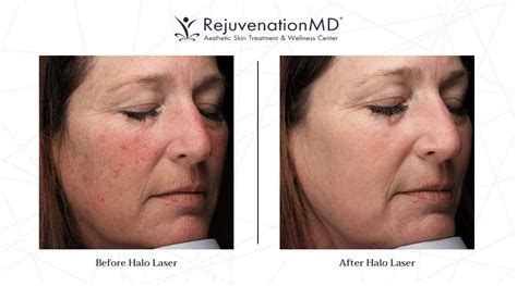 What To Expect From A Halo Laser Treatment Rejuvenationmd