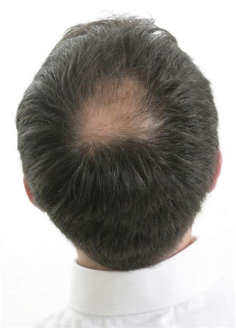 What Is The Connection Between Itching Scalp And Hair Loss