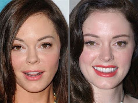 Rose Mcgowan Plastic Surgery Gone Wrong Before And After Pictures Celebrity Plastic Surgery