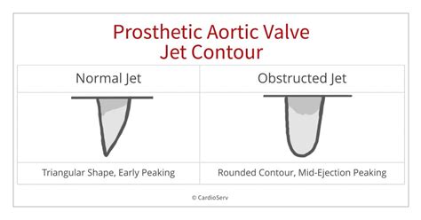 Prosthetic Aortic Valve Stenosis Cardioserv