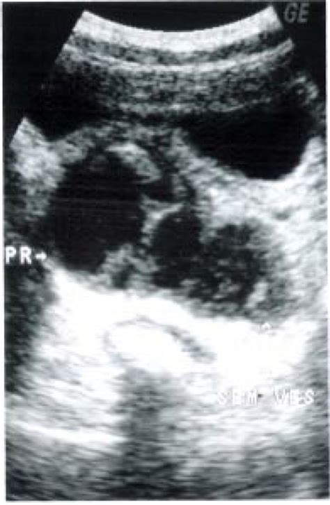 Usg Image Showing Enlargement Of The Prostate With Abscess Formation In
