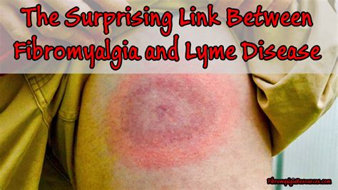 The Surprising Link Between Fibromyalgia And Lyme Disease