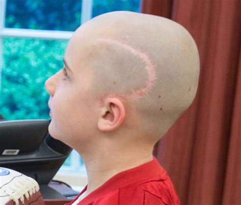 Since brain tumors in children are rare, it's important to find a healthcare team that has experience and skill in medicines can be used to replace hormones if a tumor affects natural hormone production. Jack Hoffman - Wikipedia