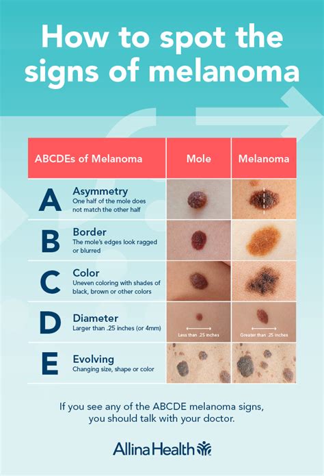 Melanoma And Your Moles Know What S New Allina Health