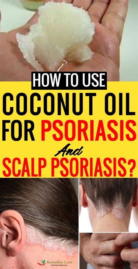 Avoid getting coconut oil on your forehead as it can block your pores, causing pimples. How to Use Coconut Oil for Psoriasis and Scalp Psoriasis ...