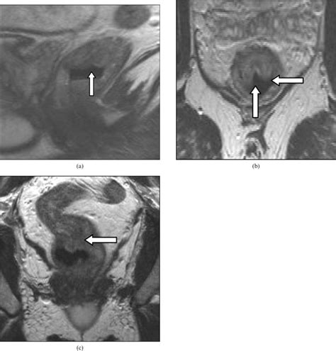 Solitary Rectal Ulcer Syndrome Mimicking Rectal Neoplasm On Mri