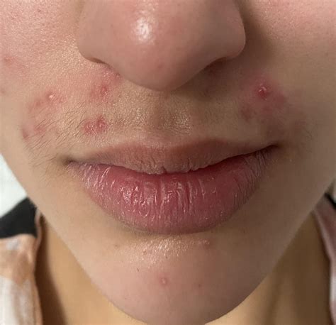 Keep Getting Breakouts On Upper Lip Sometimes Come Up In Twos Acne