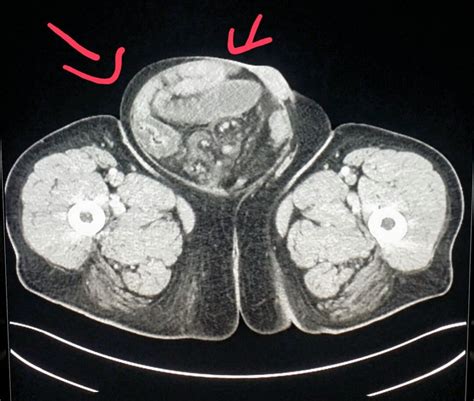 Pelvis Ct Shows A Large Hernia Inguinal With Intestine Inside In