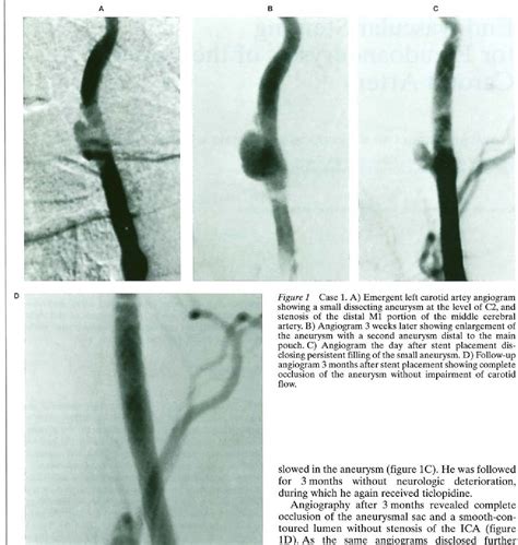 Figure 1 From Endovascular Stenting For Pseudoaneurysms Of The Cervical