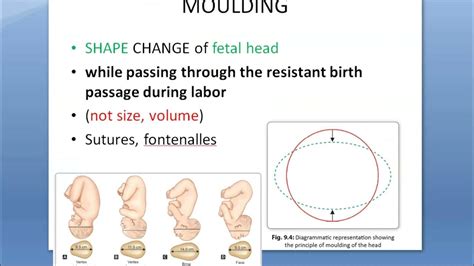 Obstetrics 119 Moulding Fetal Head Skull Adjust Supermoulding Degree