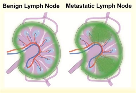 Detection Of Lymph Node Metastases By Ultra Ph Sensitive Polymeric