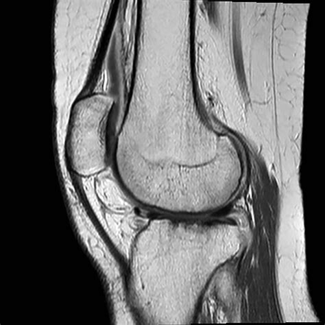 Magnetic Resonance Imaging Mri Of The Knee As An Outcome Measure In