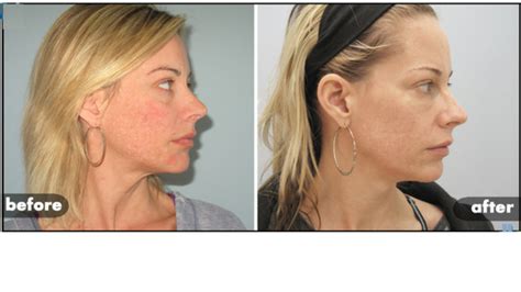 Microneedling For Acne Areton Limited