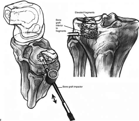 Arthroscopic Treatment Of Lateral Tibial Plateau Fractures