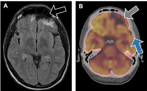 Preoperative Mri Scans Shown Lesions On The Left Medi