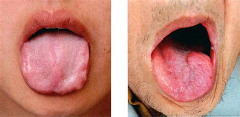 Limp Wilting Tongue In Tcm Tongue Diagnosis