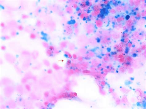 Figure 6 Bone Marrow Aspirate Smear 100x Perls Stain Showing Ringed