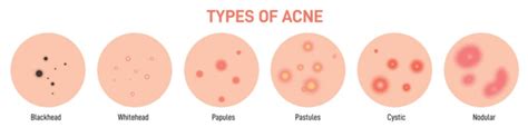Difference Between Acne And Pimples Clearskin