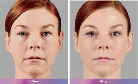 Dermal Fillers Juvederm Voluma Belotero Newport Med Center