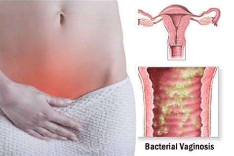 Qu Es Una Vaginitis Bacteriana Trujillo Per