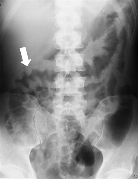 Plain Abdominal Radiographs In Patients With Crohns Disease