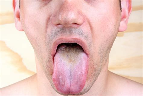 What Does It Mean When Your Tongue Is Tongue Health Colors Textures