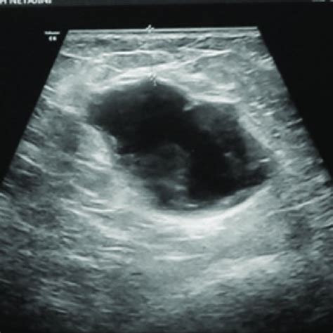 Ultrasonography Of The Right Breast Showing An Oval Lobulated Cystic