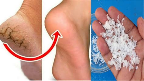 Best Way To Get Rid Of Dry And Cracked Heels At Home Youtube