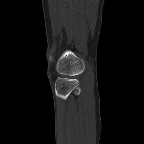 Ct Knee Radiology Imaging