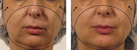 Oxygeneo® is more than microdermabrasion, more than a facial, and gentler than peels. Neue Faltenbehandlung mit Sofort-Wirkung - Bodyzone