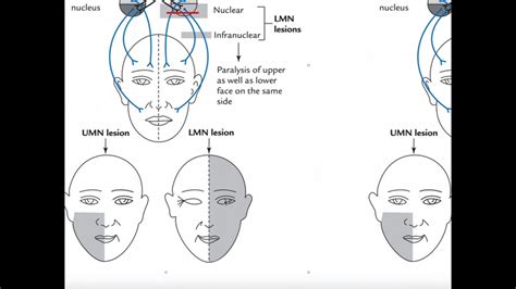 Mechanism Of Facial Bells Palsy And Clinical Interpretation Youtube