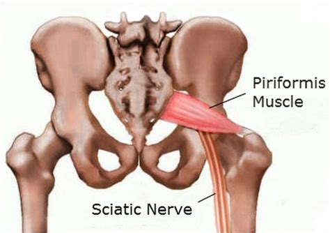 It's also called hip flexor tendonitis, or tendonitis of the hip. Piriformis Syndrome | New Health Guide