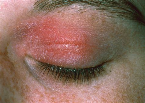 Allergic Reaction To Cosmetic Eye Make Up Photograph By Dr P Marazzi