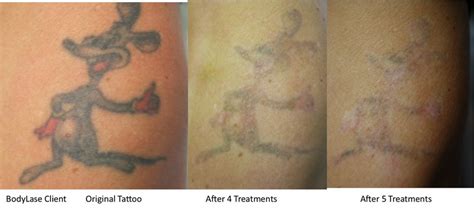 We started performing laser tattoo removal in 2011 and have performed over 6,000 procedures. Laser Tattoo Removal Before and After Gallery | BodyLase ...