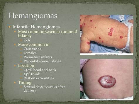 Ppt Hemangiomas And Vascular Malformations Powerpoint Presentation Free Download Id780098