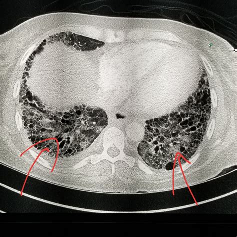 Pulmonary Fibrosis Ct Chest