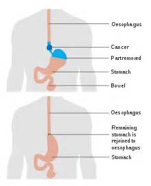 They are both certified by the american board of plastic surgery and members of the american society of plastic surgeons. Esophagectomy - Wikipedia
