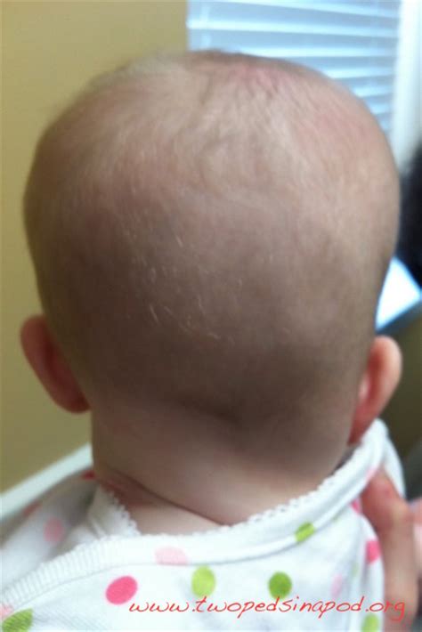 Why Is My Babys Head Flat About Plagiocephaly Two Peds In A Pod