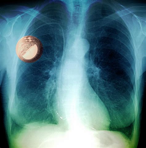 Heart Pacemaker Photograph By Zephyrscience Photo Library