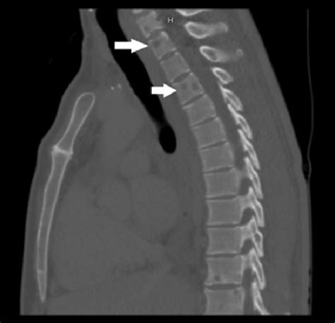 Sagittal Ct Scan View Showing Multiple Tiny Vertebral Lytic Lesions