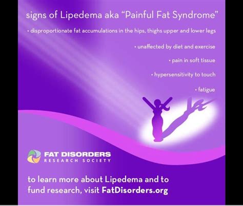 Dercums Disease Lipedema Syndrome Disorders Society Thighs Fat