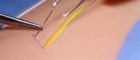 Subcuticular Suture Osce Guide Surgical Skills Geeky Medics