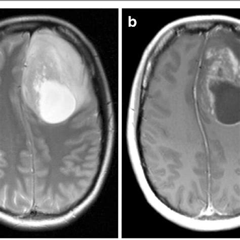 A Heterogeneous Tumor 65 × 50 Mm In The Left Frontal Lobe With Solid